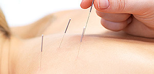 Acupuncture ACC